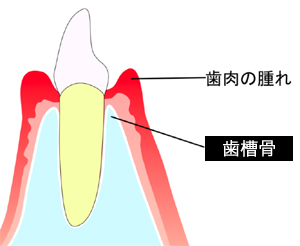 歯槽骨の吸収について